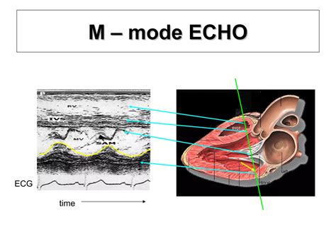 Systolic Anterior Motion Of Mitral Valve Sam Ppt