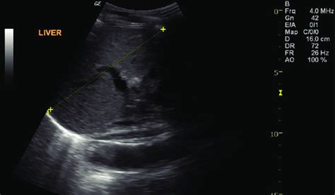 Ultrasound Image Of Liver Showing Echo Texture And Nodular Margin