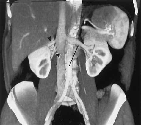 Three Dimensional Volume Rendered Ct Angiography Of The Renal Arteries And Veins Normal Anatomy