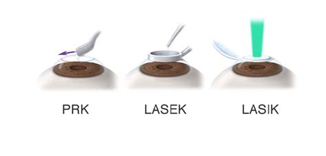 LASEK and PRK - EyeSTAR LASIK Institute Eye Laser Surgery in 3 steps