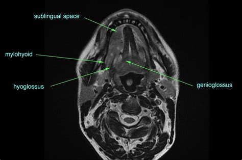 Tongue Muscles Ct Anatomy