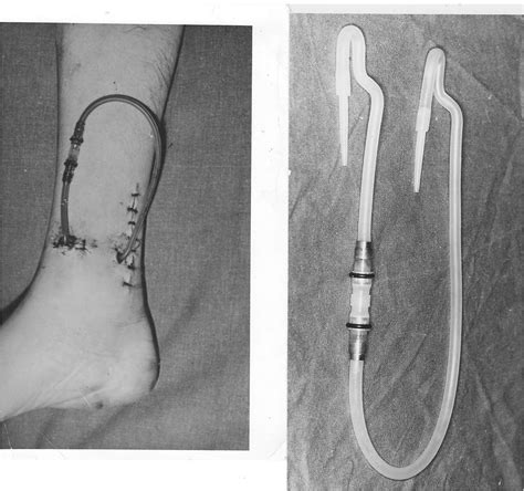 Vascular Access For Hemodialysis IntechOpen