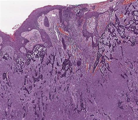 ¿qué Es El Carcinoma Basocelular Y Por Qué Debes Conocerlo Clínica