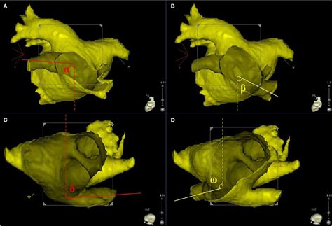 Frontiers Comparison Of Using Second Generation Cryoballoon And Radiofrequency Catheter For