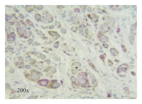 A Macroscopic View Of The Excised Tumor B Hematoxylin And Eosin