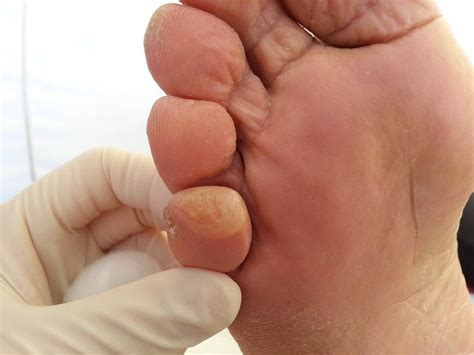 Toe Blister Treatment Prevention Blister Prevention