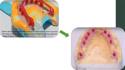 Basal implant - a newer variety of implant system | PPT