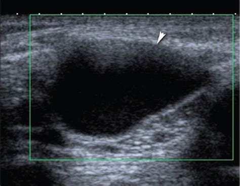 Ultrasound And Doppler Us In Evaluation Of Superficial Soft Tissue