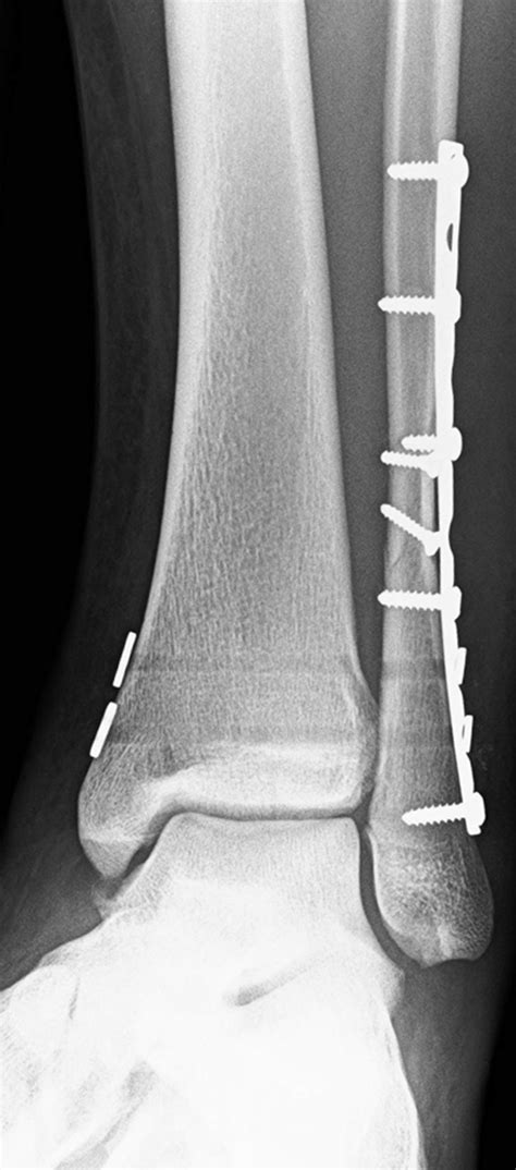 Postoperative left anterior-posterior ankle radiograph after open ...