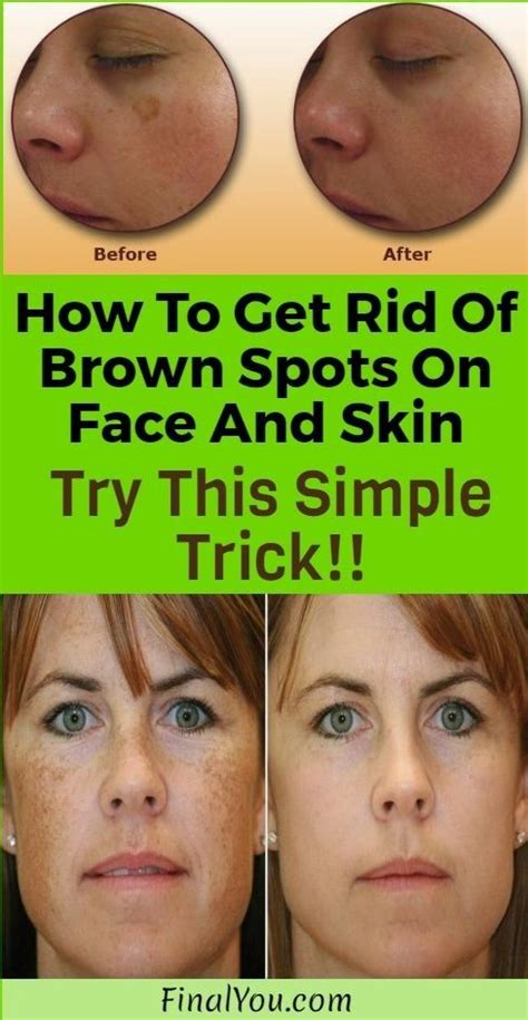 How To Get Rid Of Brown Spots On Face And Skin Try This Simple Trick