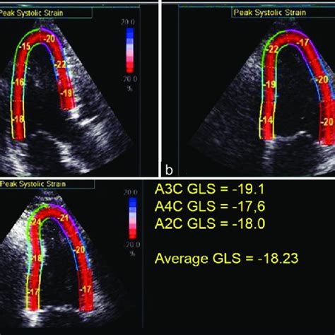 PDF Global Longitudinal Strain A Practical Step By Step Approach To