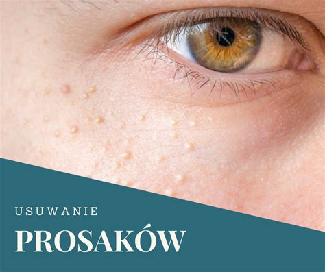 USUWANIE PROSAKÓW - Gabinet Kosmetyczny Gdańsk Morena