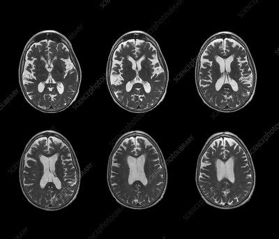 Early Onset Alzheimer S Disease MRI Scan Stock Image C018 0505