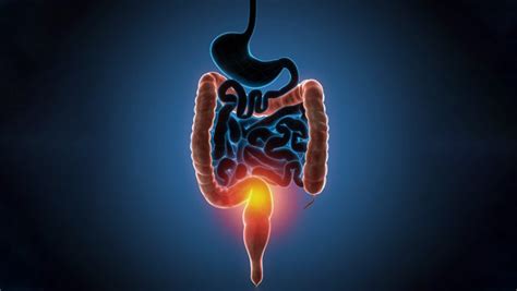 Colitis Ulcerosa Causas S Ntomas Y Tratamiento Md Sa De