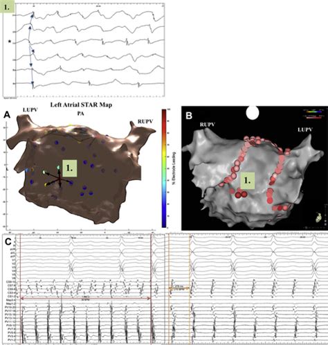 Ablation In Persistent Atrial Fibrillation Using Stochastic Trajectory