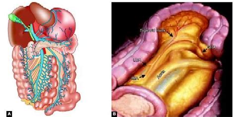 Laparoscopic Sigmoidectomy Surgery