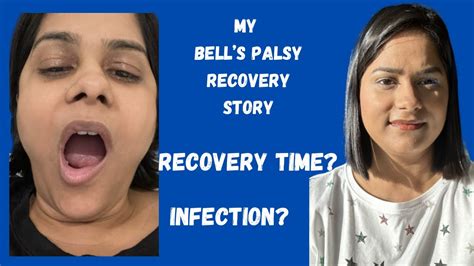 How I Recovered From Bell S Palsy Facial Paralysis Youtube