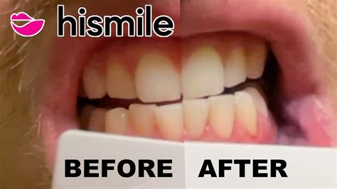 My Experience Using The Hismile V34 Colour Corrector, 54% OFF