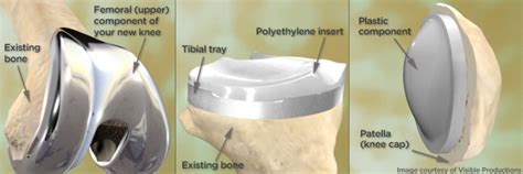 Types Of Knee Replacement Options