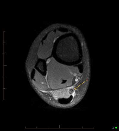 Plantaris Tendon Rupture Mri | SexiezPicz Web Porn