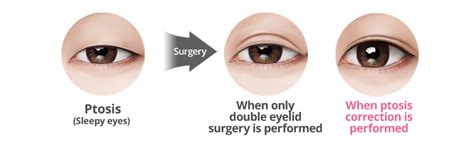 Ptosis Correction In Korea Completes Defined And Clear Look 【id Hospital】