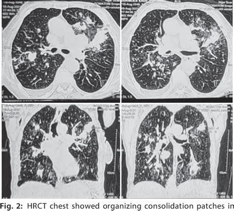 Figure 2 From A Rare Case Of Cryptogenic Organizing Pneumonia With Sarcoidosis Overlap