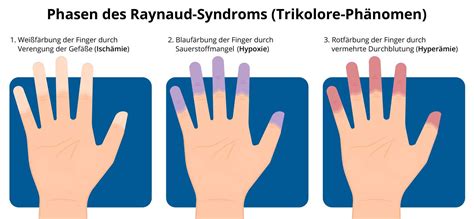 Raynaud Syndrom Ursachen Symptome Therapie Prognose