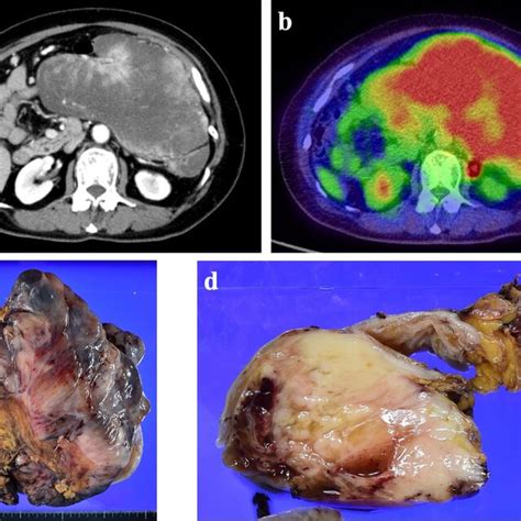 A Contrast Enhanced CT Findings Revealed A Large Submucosal Mass