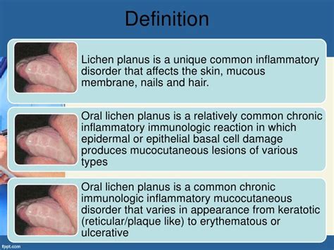 Oral Lichen Planus Olp