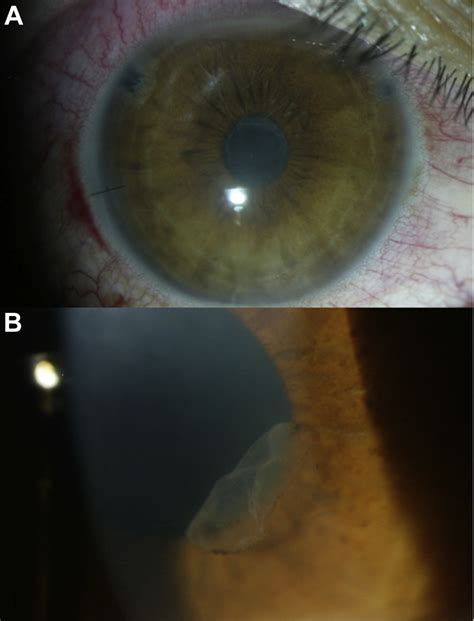 Toxic Anterior Segment Syndrome A Review Survey Of Ophthalmology