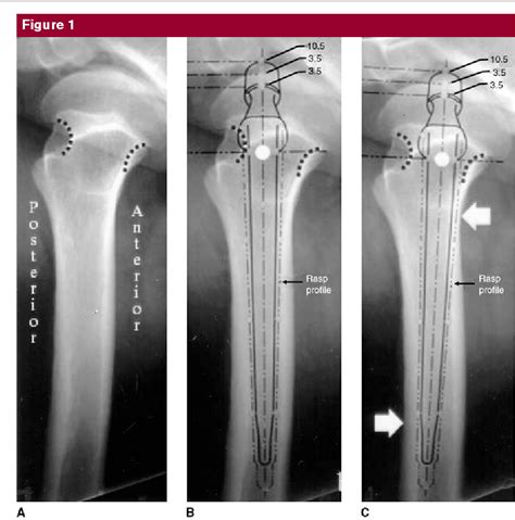 Figure 1 From Preoperative Planning For Primary Total Hip Arthroplasty