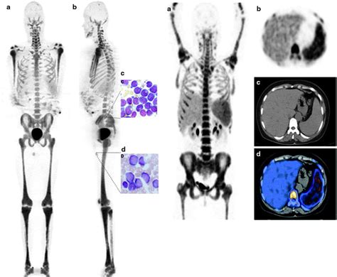 Multiple Myeloma | Radiology Key