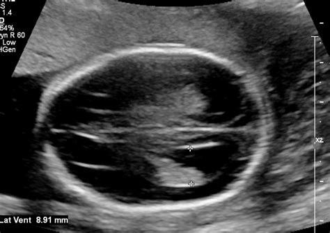 Corpus Callosum Agenesis Ultrasoundpaedia