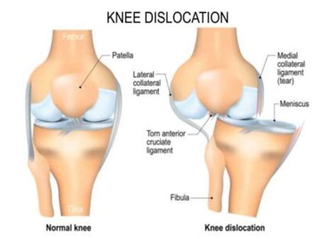 Knee Dislocation | Knee Dislocation Injury | Orthopedic Knee Specialist | Manhattan, Brooklyn ...