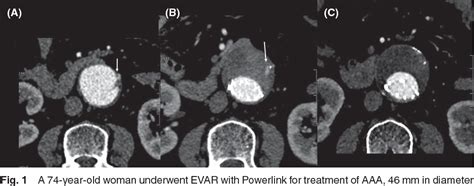 Figure 1 From Ct Findings Of Risk Factors For Persistent Type Ii