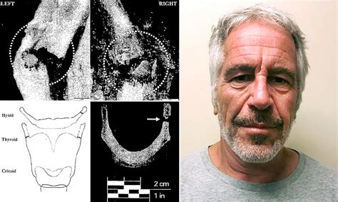 New Autopsy Photos Of Jeffrey Epstein Raise Questions About His Death