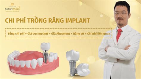 Mới Nhất 2024 Trồng răng Implant giá bao nhiêu Bảng giá Chuẩn Y Khoa