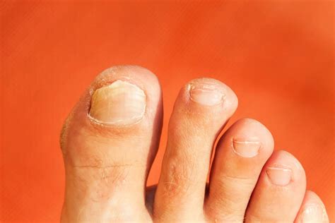 The Essentials Of Fungal Toenail Infections The Running Advisor