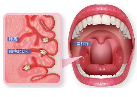 簡單認識扁桃腺結石 快樂小藥師 Im Pharmacist Nichts Glücklich 痞客邦