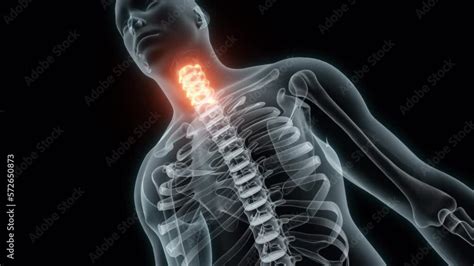 3D Rendering of a Medical Animation of the Cervical Vertebrae. X-ray of ...