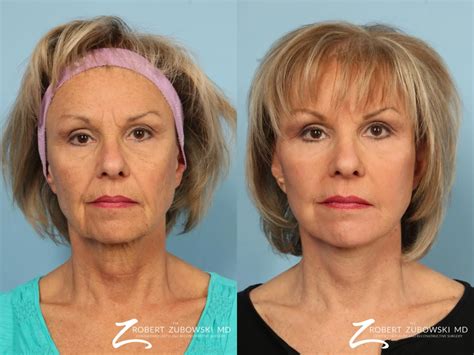 Facelift Before After Gallery Patient 1