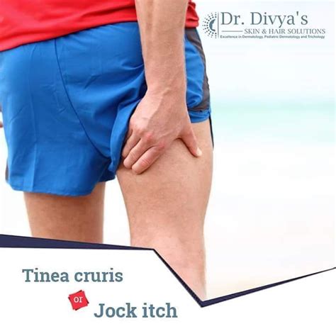 Jock Itch Is A Fungal Infection Which Affects The Groin Area Causing