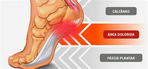 Fascite Plantar Ou Espor O Do Calc Neo Ortopedia