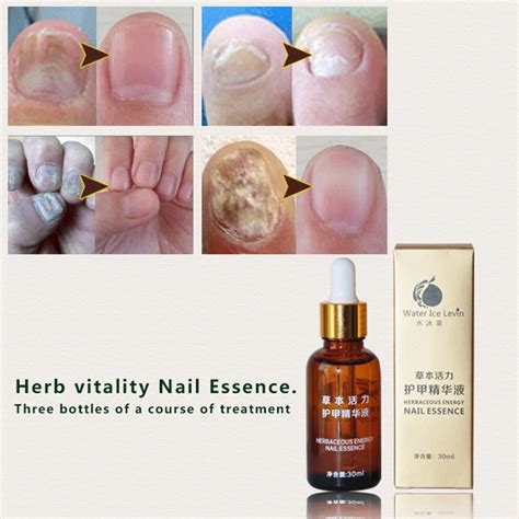 1Pcs Water Ice Levin Fungal Nail Treatment Essence Nail and Foot ...