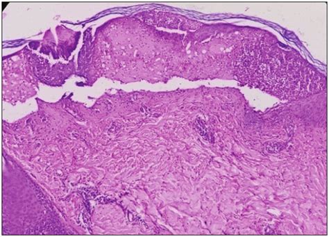 Microphotograph Of Erythema Multiforme Showing Dermoepidermal