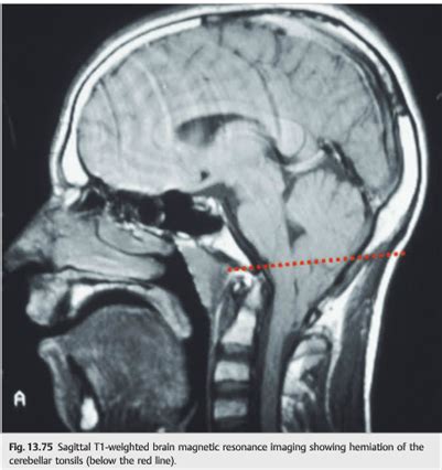 Questions of the week: NOI13 Diplopia 5 – 6th Nerve Palsy — Neuro ...