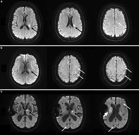 Lacunar Infarct