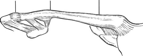 Operative Treatment Of Fractures Of The Clavicle Musculoskeletal Key