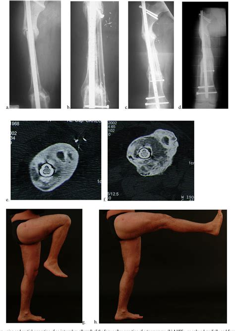 Figure From Vascularised Fibular Grafts As A Salvage Procedure In