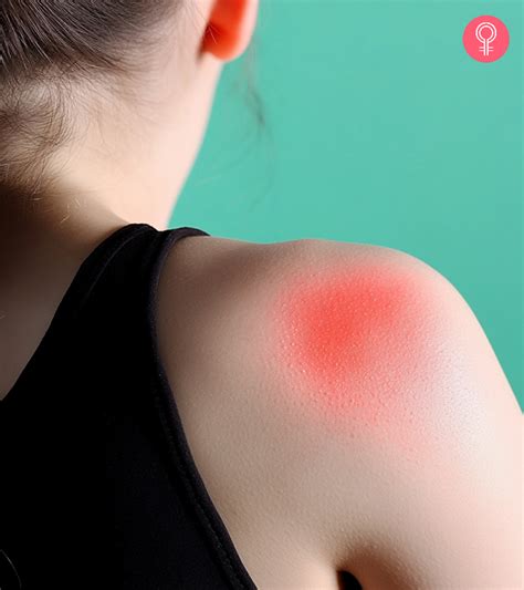 28 Home Remedies For Prickly Heat That Provide Quick Relief